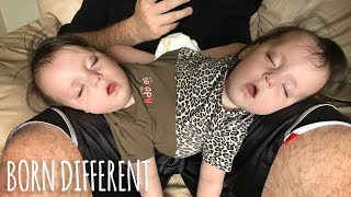 Conjoined Twins Are A Medical Miracle  BORN DIFFERENT [upl. by Tneciv]