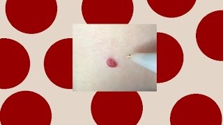 Cherry Angioma Removal [upl. by Isadore728]