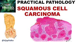 SQUAMOUS CELL CARCINOMA Clinical features amp Morphology Premalignant lesions [upl. by Sura]