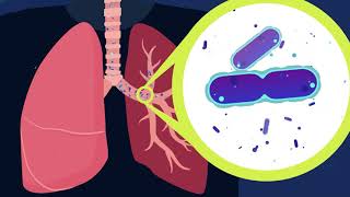 What is NTM Lung Disease [upl. by Aerdnad722]