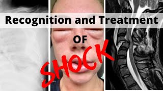 Recognition and Treatment of Shock [upl. by Shoshanna]