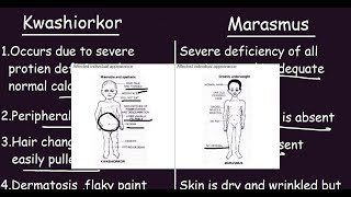 Kwashiorkor vs Marasmus Quick Differences amp Comparison [upl. by Eserahc]