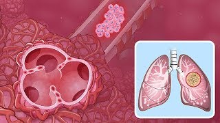 Understanding NonSmall Cell Lung Cancer [upl. by Holtorf]