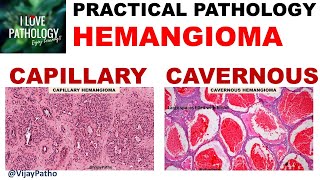 Hemangioma treatment with the PerioLase MVP7 [upl. by Aehsrop631]