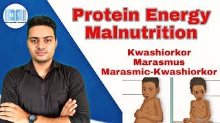 Protein Energy Malnutrition  Kwashiorkor Vs Marasmus [upl. by Annahaj707]