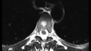 Treatment of Capillary Angiomas [upl. by Montagna]