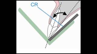 Bisecting Angle Technique TIPS [upl. by Akeihsal94]