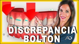 👩🏻‍⚕️Discrepancia de BOLTON👨🏻‍⚕️Analisis de la discrepancia de BOLTON en ORTODONCIA [upl. by Notsua]