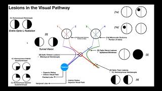 Lesions to the Visual Pathway EXPLAINED [upl. by Sherj]