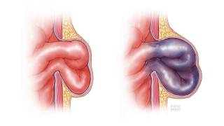 Inguinal Hernia Repair Surgery Risks and Outcomes  CHI Health [upl. by Mide]