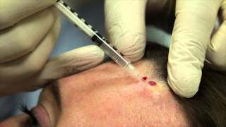 Cherry Angioma Treatment with Excel V Laser [upl. by Kitarp911]