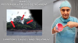 What is Posterior Vitreous Detachment PVD Symptoms Causes and Treatment [upl. by Schwenk832]