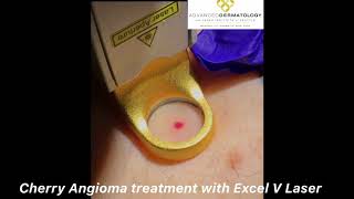 Cherry Angioma Removal Treatment with Cuteras Excel V Laser [upl. by Kaiser]