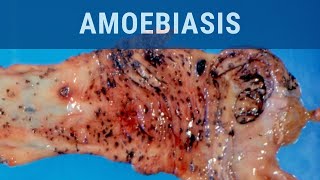 Amoebiasis  Pathology mini tutorial [upl. by Dorree]