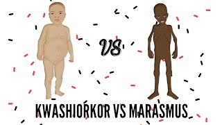 SAM  Severe Acute Malnutrition  Kwashiorkor VS Marasmus [upl. by Sokim]