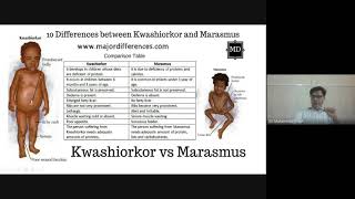 MARASMUS  CAUSES  SYMPTOMS  DIAGNOSIS  TREATMENT  MALNUTRITION IN CHILD in hindi [upl. by Elyr]