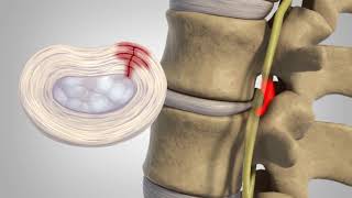 Herniated Disc  Patient Education [upl. by Wahlstrom]