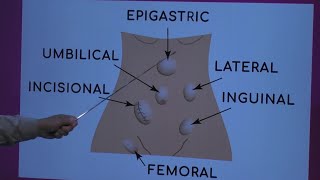 Types of Hernia [upl. by Lewellen917]