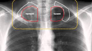 Pancoast Tumor amp Horner Syndrome [upl. by Anahpets]