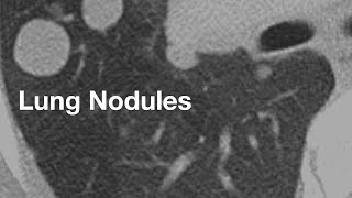 Lung Nodules basics for patients [upl. by Heigl22]