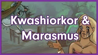 Marasmus Difference Between Marasmus Cachexia and Kwashiorkor [upl. by Doralynne]