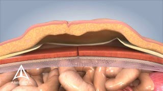 Ventral Hernia Repair  3D Medical Animation [upl. by Friedland]