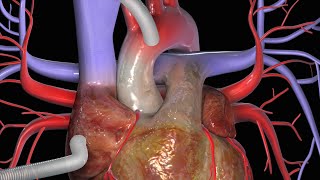 Cirurgia de Revascularização do Miocárdio CRM [upl. by Ettenahs]