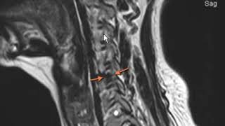 Disc Herniation What Does it Mean amp How Can I Manage It [upl. by Assilac489]