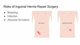 Introduction to Direct and Indirect Inguinal Hernia [upl. by Adnanref630]